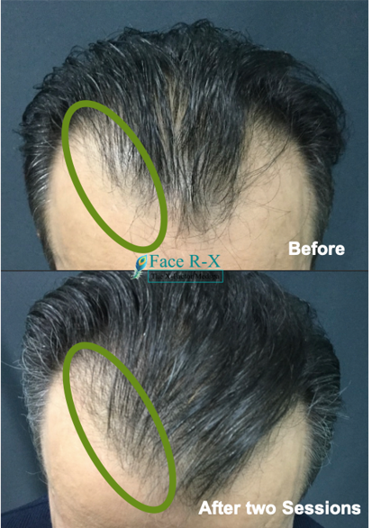 Center of Excellence in Pain   Regenerative Medicine | P-shot, Mesenchymal Stem Cells  MSCs  and PRP for Hair Loss