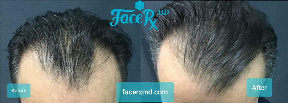 Center of Excellence in Pain   Regenerative Medicine | Interventional Pain Management, PRP Injection for Joint Pain and O-shot