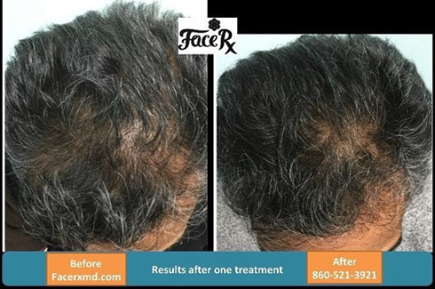 Center of Excellence in Pain   Regenerative Medicine | PRP Injection for Joint Pain, P-shot and Interventional Pain Management